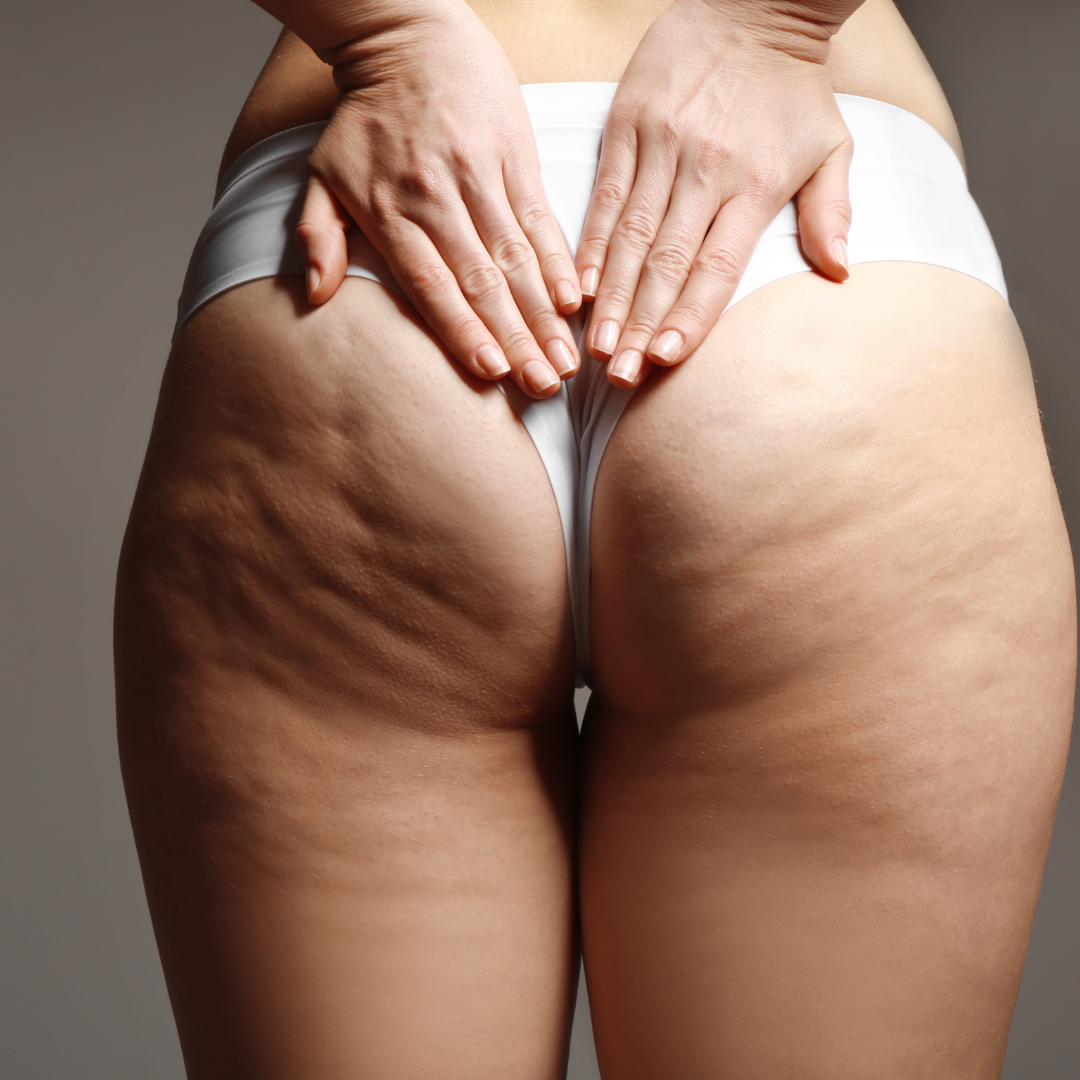 Traitement fesses raffermissantes sans chirurgie